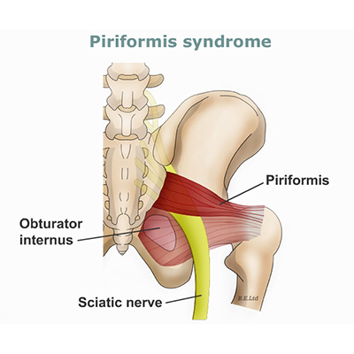 Piriformis Syndrome Sciatic Nerve
